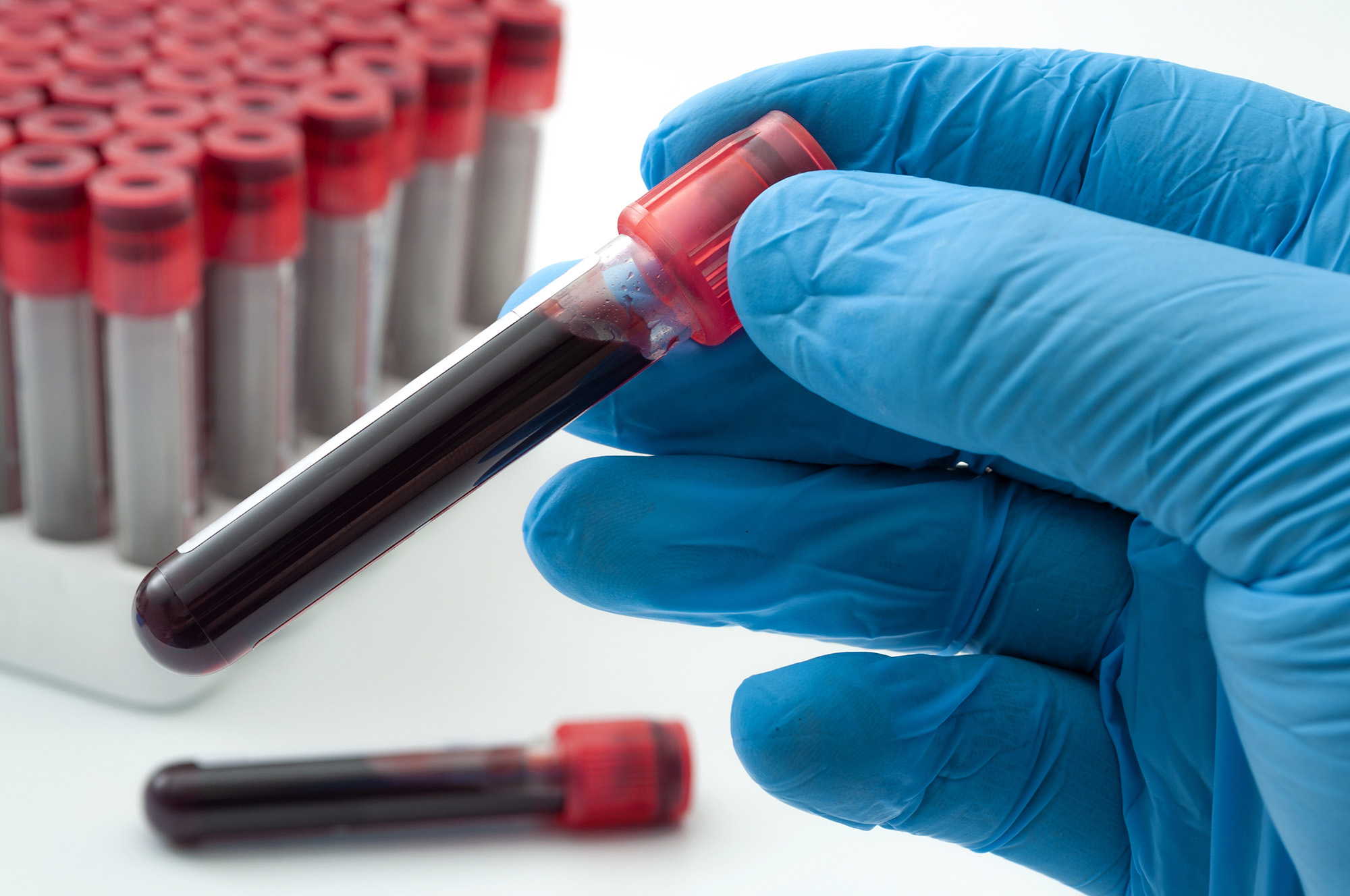 Blood analysis, clinical or medical testing and phlebotomy techician Blood analysis, clinical or medical testing and phlebotomy technicain